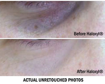 Haloxyl-pic.jpg